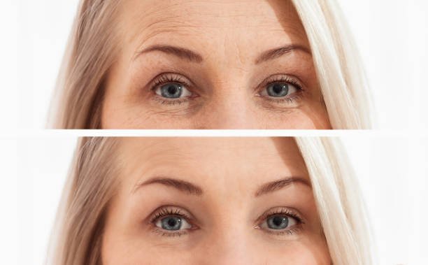 Anti Aging results before after image