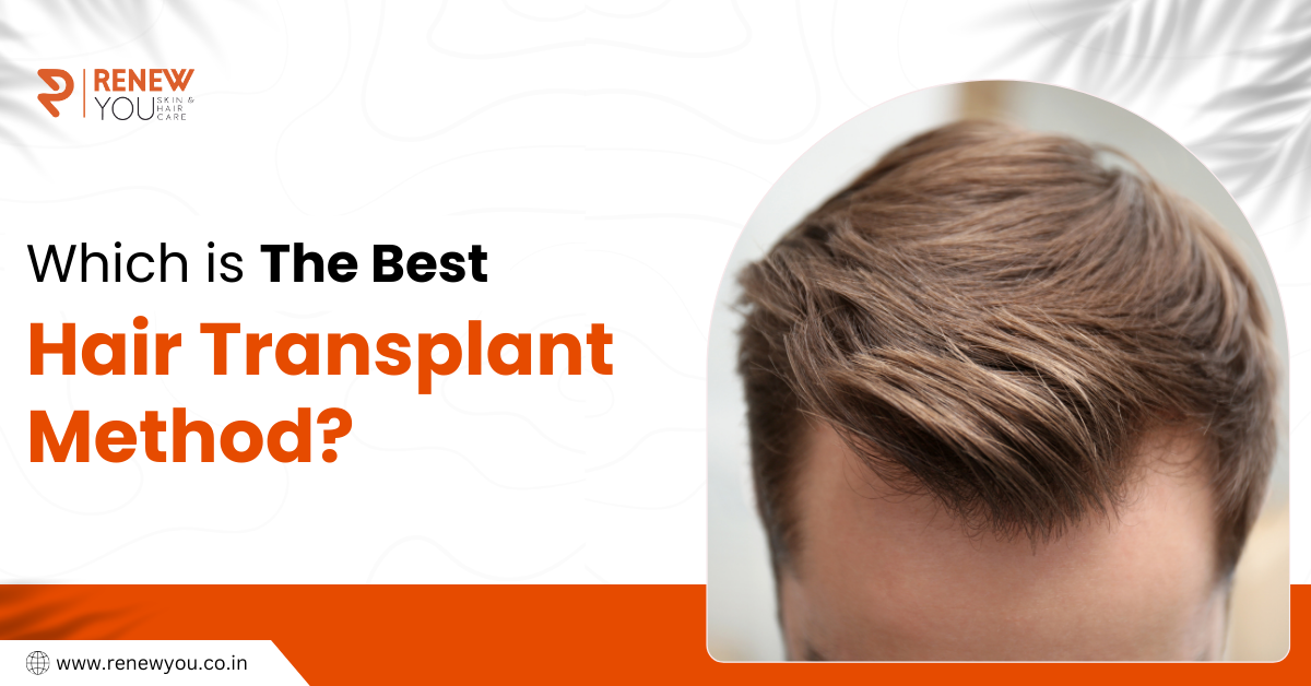 Best hair transplant