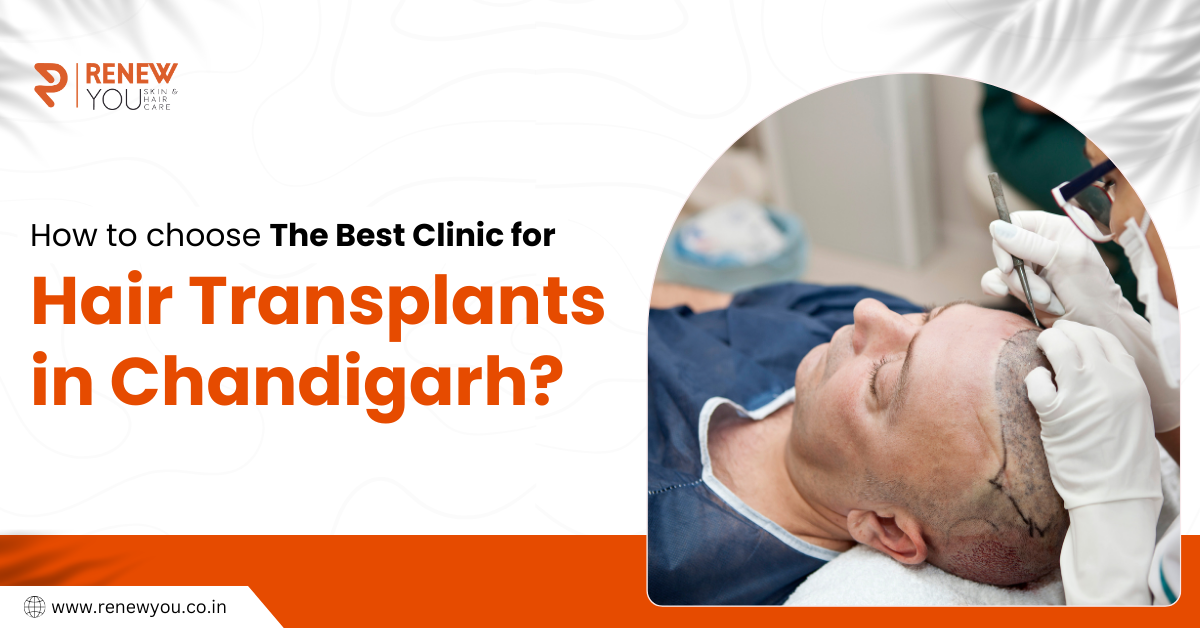 hair transplant in chandigarh