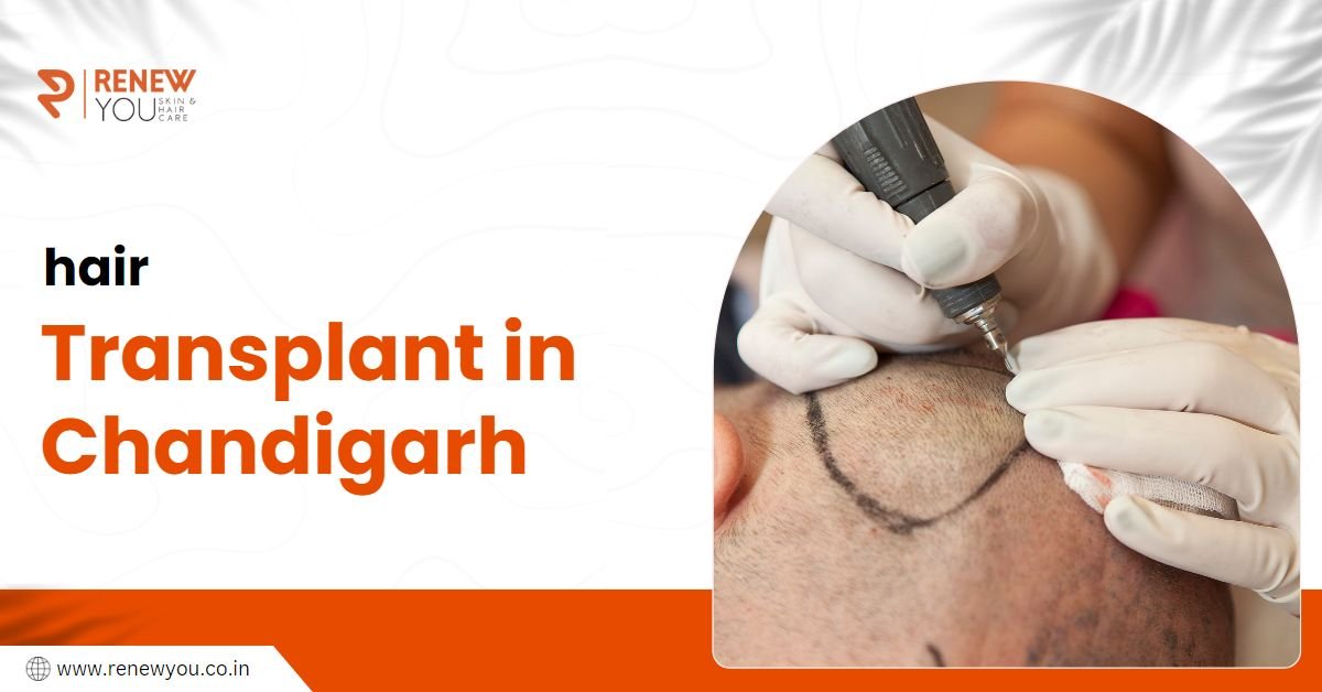 Hair Transplant in Chandigarh