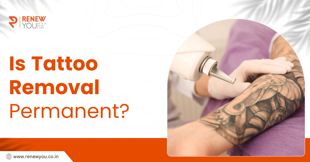 Is tattoo removal permanent?