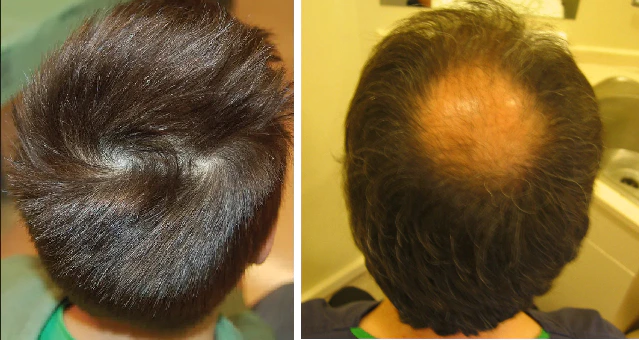 Before and after results of hair transplant