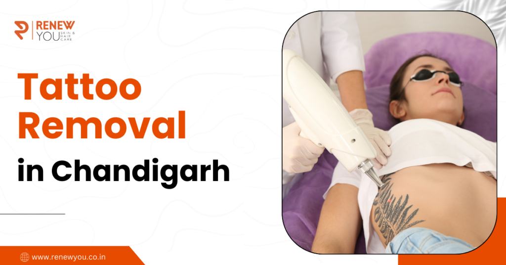 Tattoo removal in Chandigarh