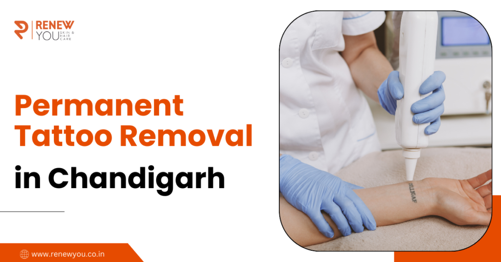 permanent tattoo removal in Chandigarh