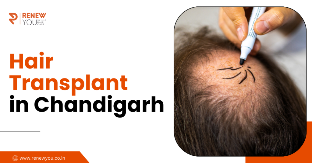 Hair transplant in Chandigarh