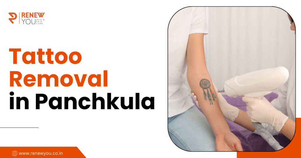 Tattoo Removal in Panchkula