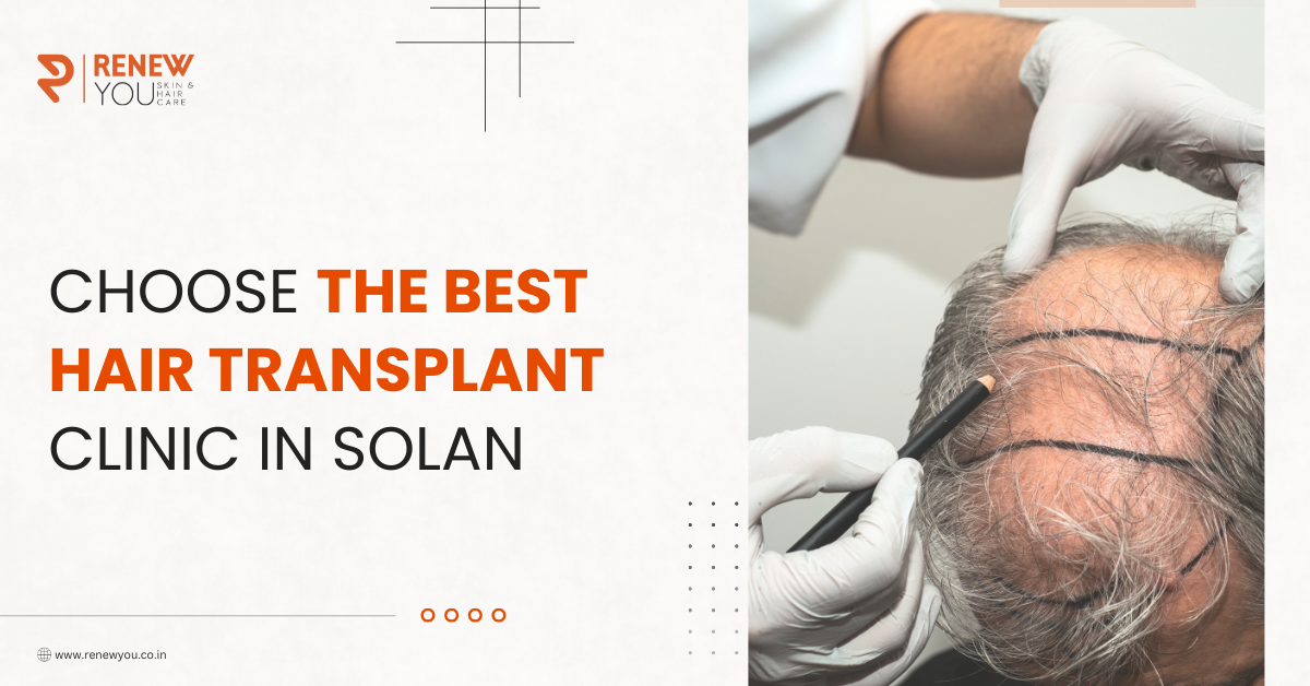 Best Hair transplant in Solan