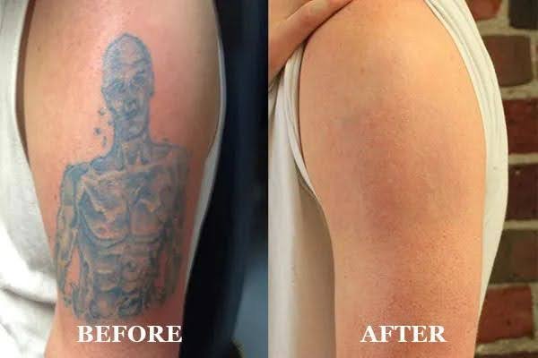 Tattoo removal results