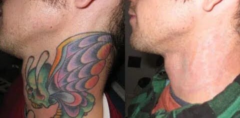 Tatto remove from neck result