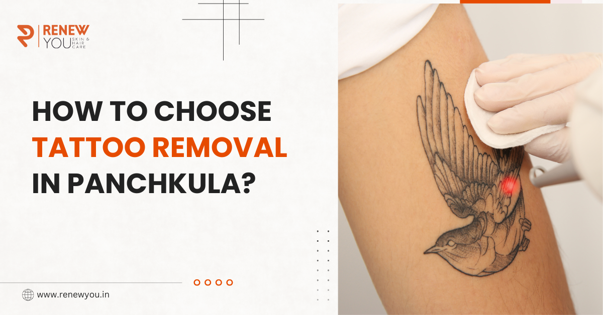 tattoo removal in panchkula