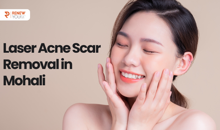 Laser Acne Scar Removal in Mohali